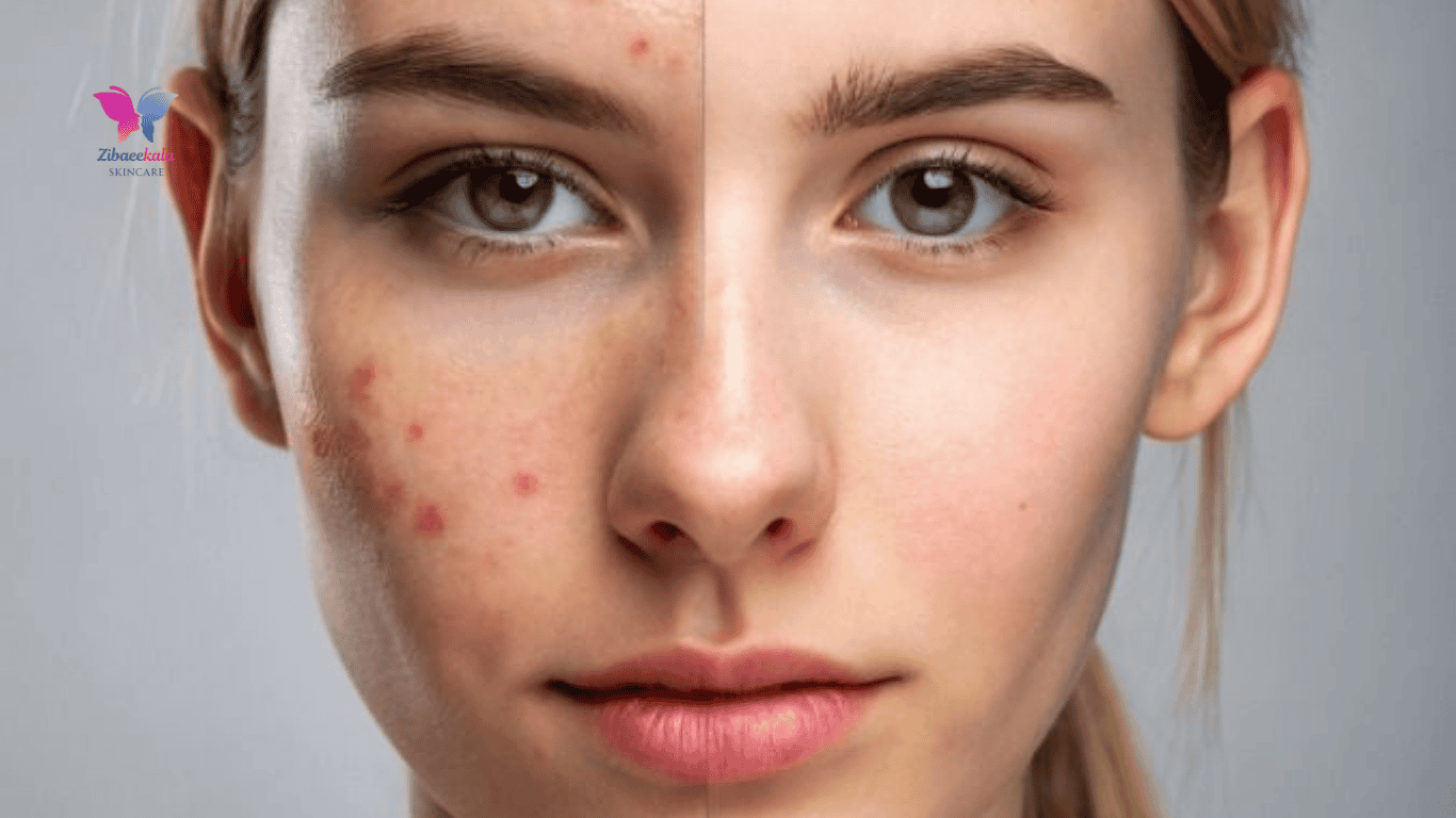 راهنمای کامل برای جلوگیری از جوش صورت