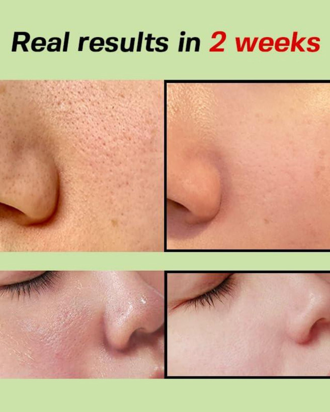 آمپول گوجه فرنگی سبز برای بستن منافذ و بهبود بافت پوست